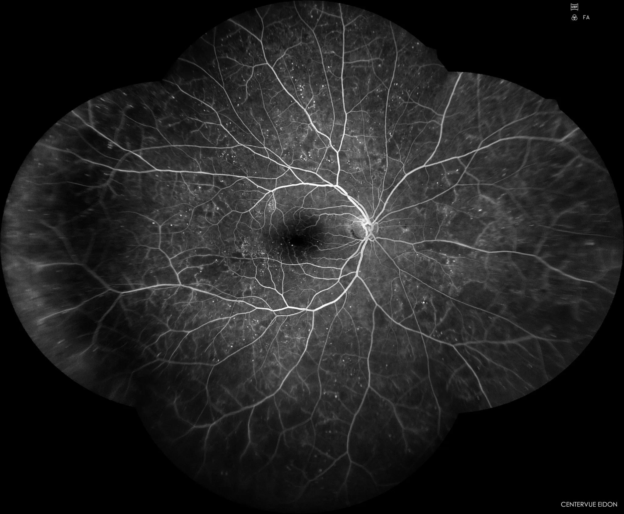 Angiografia de campo extra-largo